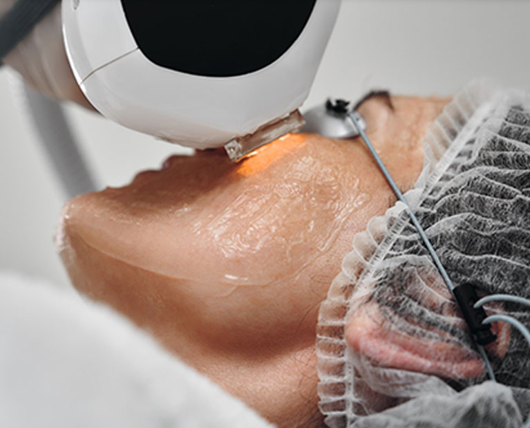 intense-acne-facial